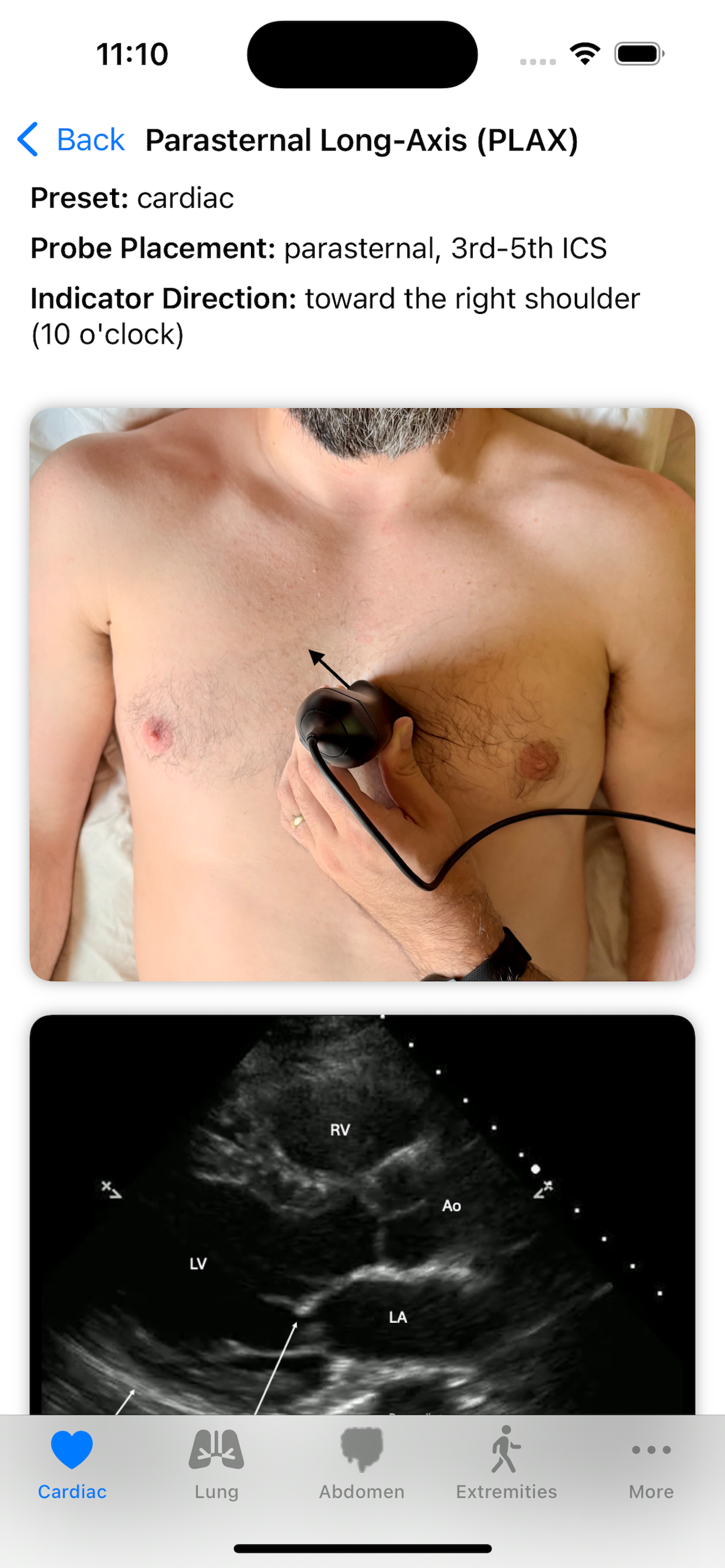 PLAX detail page with probe placement instructions and a labeled ultrasound image